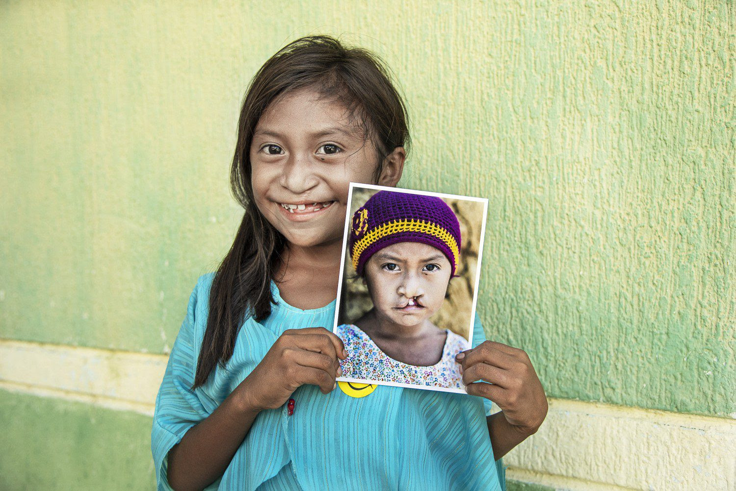 Lexxi smiling holding a photo of herself before cleft lip and cleft palate surgery